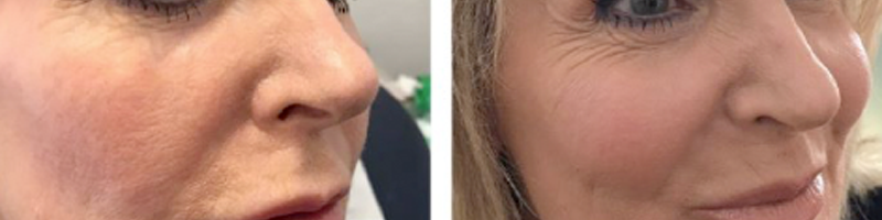 Farbella - Dermal Fillers Treatments