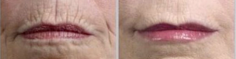 Farbella - Anti Wrinkle Treatments